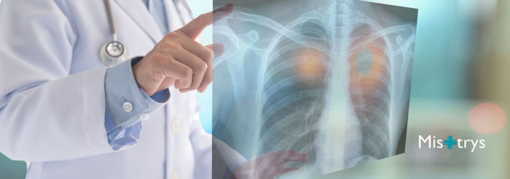 Medical professional holding lung X-ray to illustrate pneumonia risks