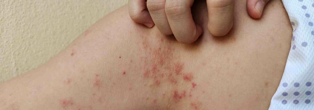 Impetigo NHS Pharmacy First treatment. 